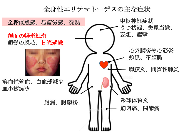 連載 ばぁばみちこコラム 第三十四回 赤ちゃんに問題となる妊娠合併症 全身性エリテマトーデス ここすまネット