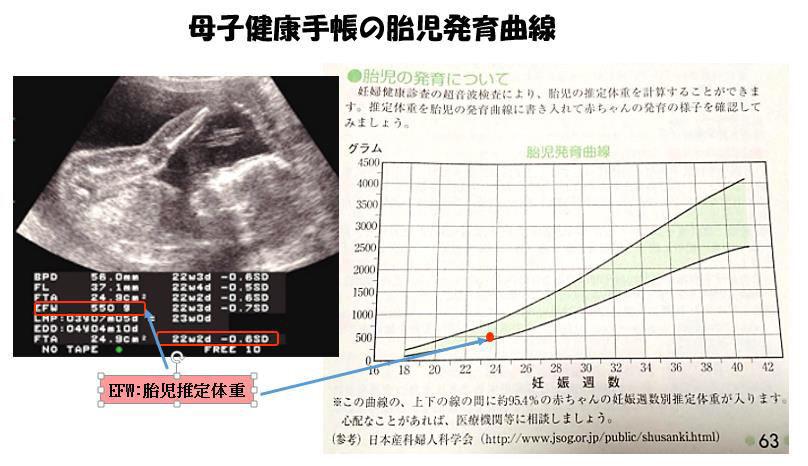 連載ばぁばみちこコラム 第四十二回 赤ちゃんに問題となる妊娠合併症 胎児発育不全 ここすまネット